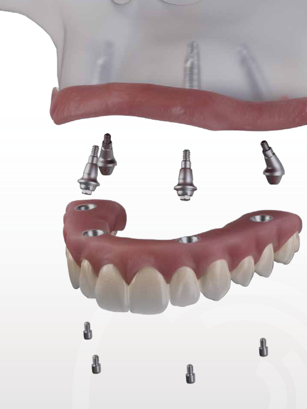 All-on-4 exploded view — 4 dental implants supporting a fixed full-arch zirconia bridge
