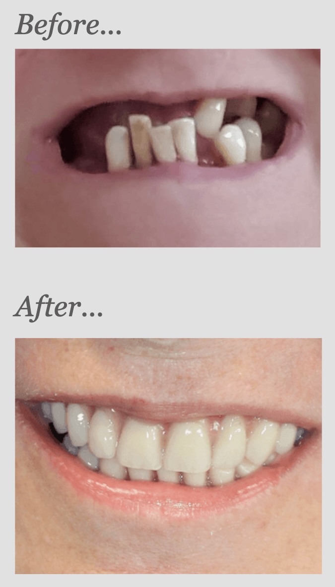All-on-4 case — before and after, showing failing dentition replaced with full-arch implant-supported teeth