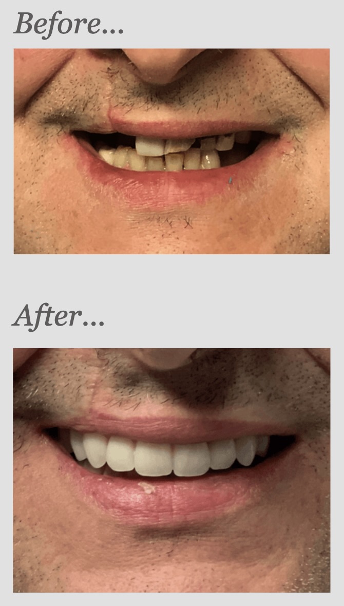Multiple implant case — before and after, showing missing and damaged teeth replaced with implant-supported restorations