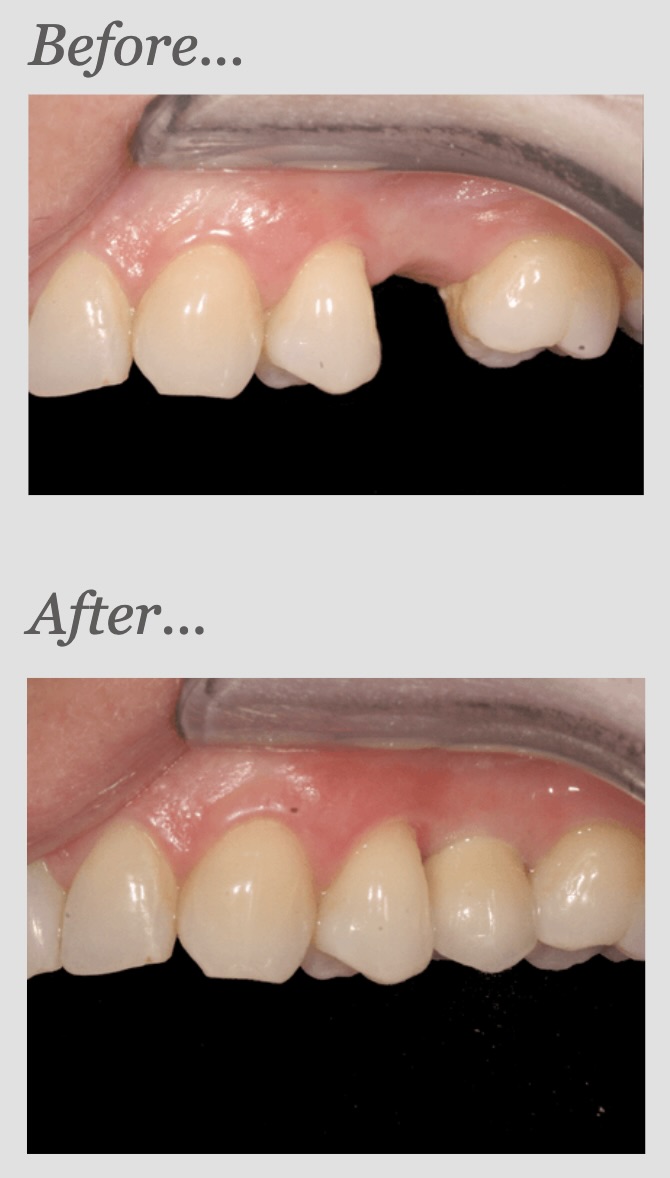 Single tooth implant case — before and after, showing missing upper premolar replaced with implant crown