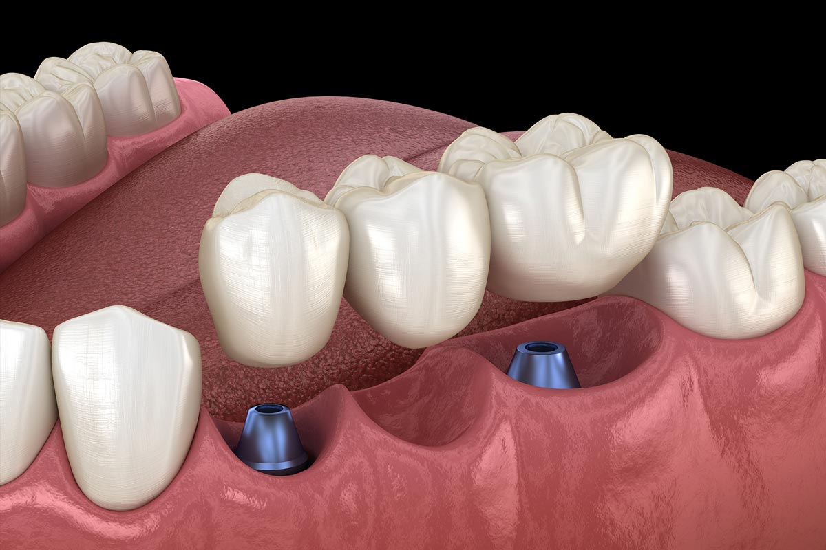 Implant-supported bridge illustration: two implant fixtures in the jaw bone supporting a 3-unit bridge, the middle tooth being a pontic