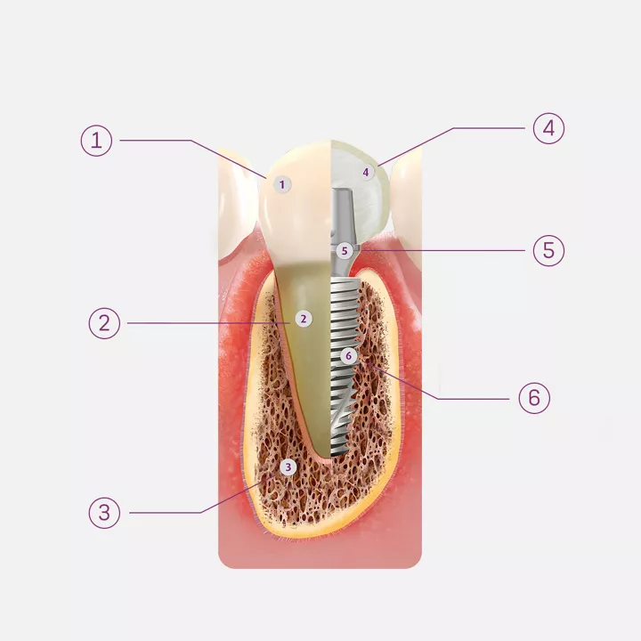 Comparison illustration: natural tooth (1 crown, 2 root, 3 bone) vs dental implant (4 crown, 5 abutment, 6 implant fixture)